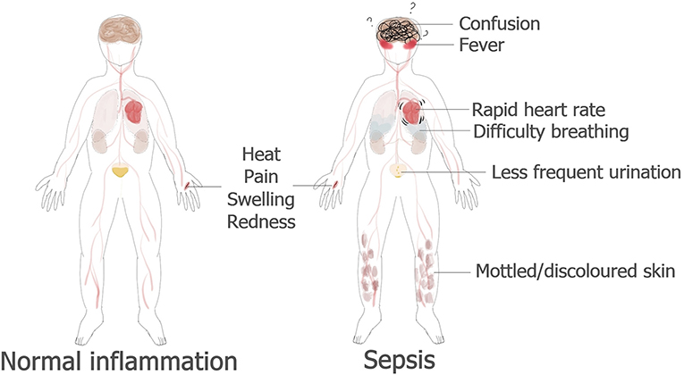 图1 -正常炎症与败血症比较。