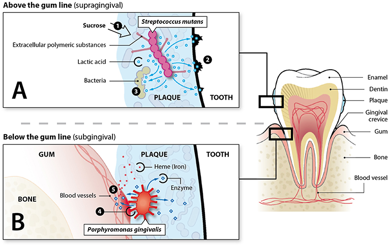 图1 -生活在牙龈线上下的细菌会损害牙齿和牙龈。