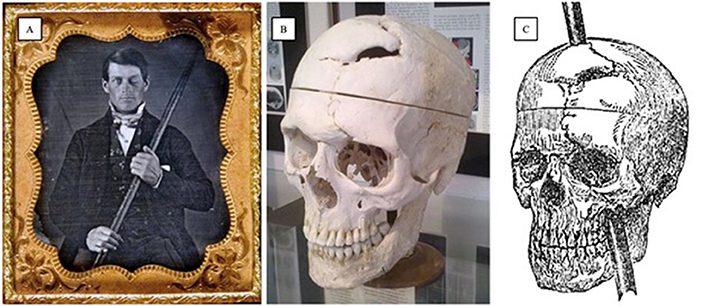 (图1)-一个菲尼亚斯,盖奇的照片拿着填塞杆贯穿他的大脑。